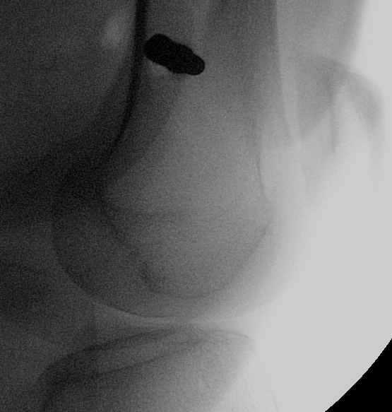 Femoral Steinman Pin Lateral